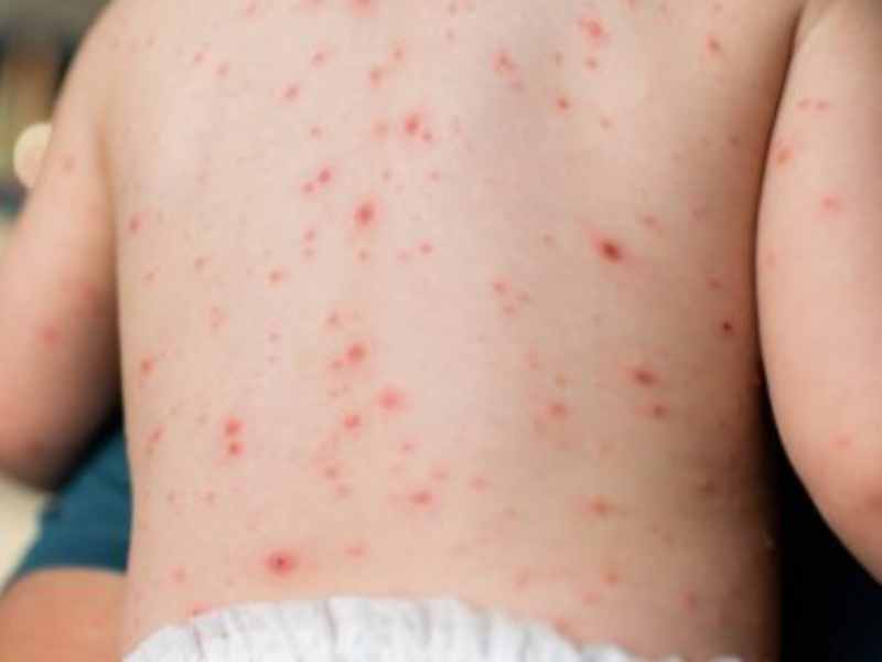 measles symptoms treatment