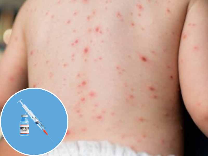 measles vaccination bangladesh